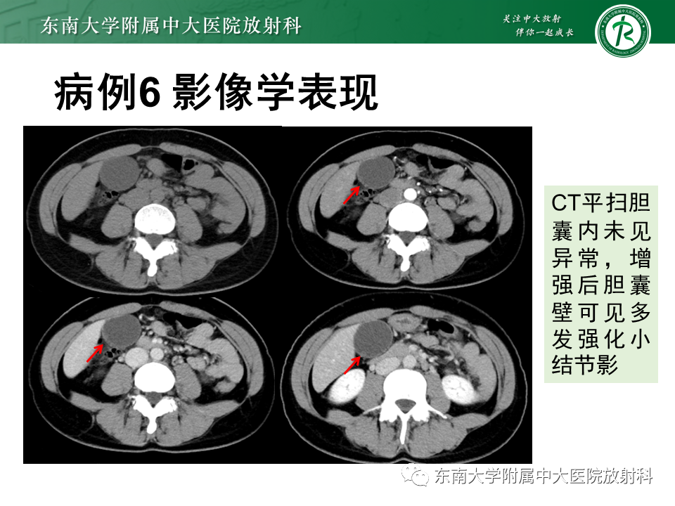 影像PPT - 【PPT】胆囊癌-51 影像PPT - 【PPT】胆囊癌-51