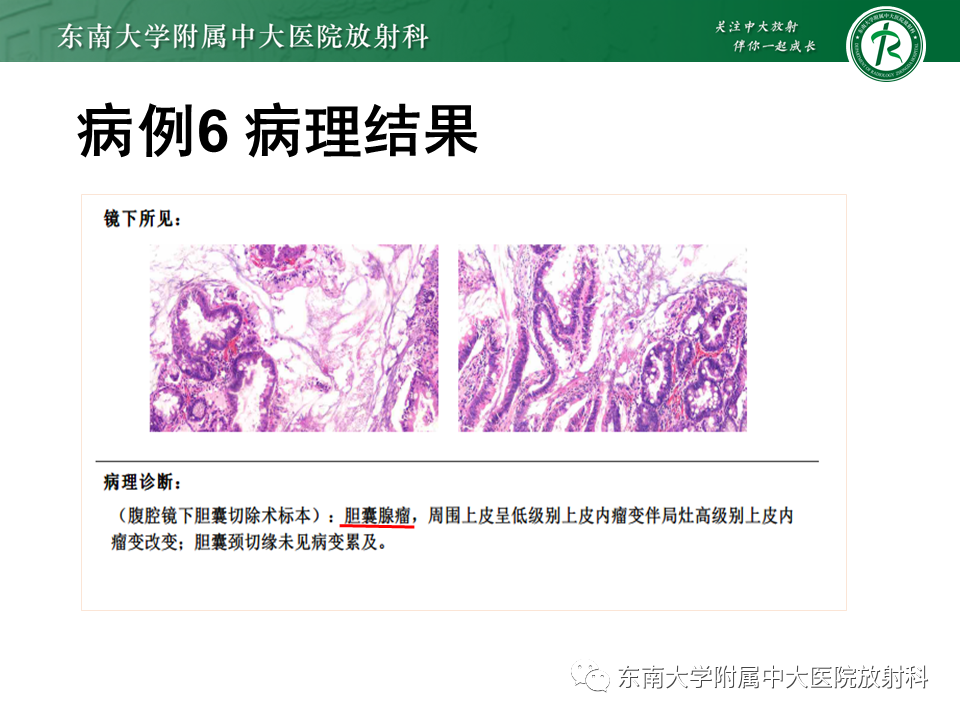 影像PPT - 【PPT】胆囊癌-52 影像PPT - 【PPT】胆囊癌-52
