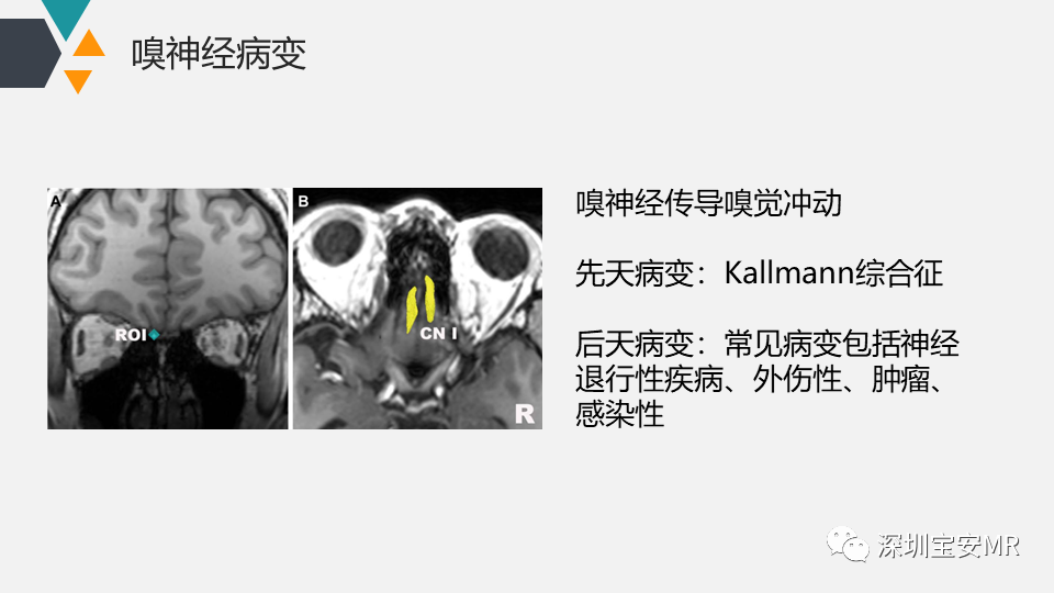 影像PPT - 【PPT】脑神经影像学与相关病变-6