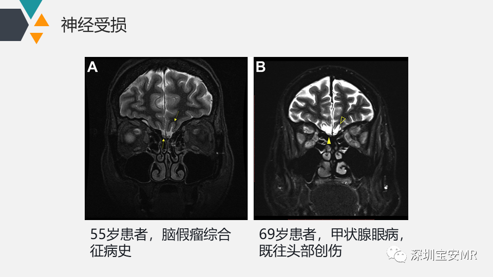 影像PPT - 【PPT】脑神经影像学与相关病变-8