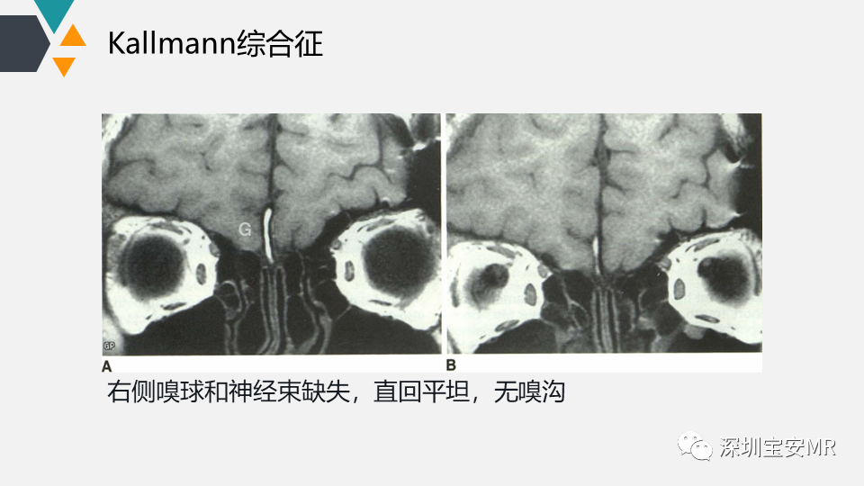 影像PPT - 【PPT】脑神经影像学与相关病变-7