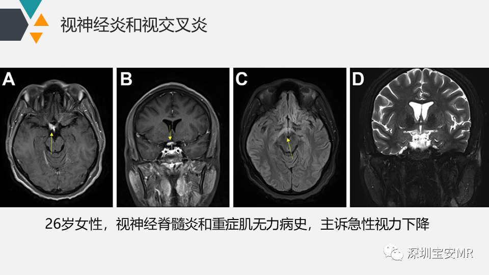 影像PPT - 【PPT】脑神经影像学与相关病变-14