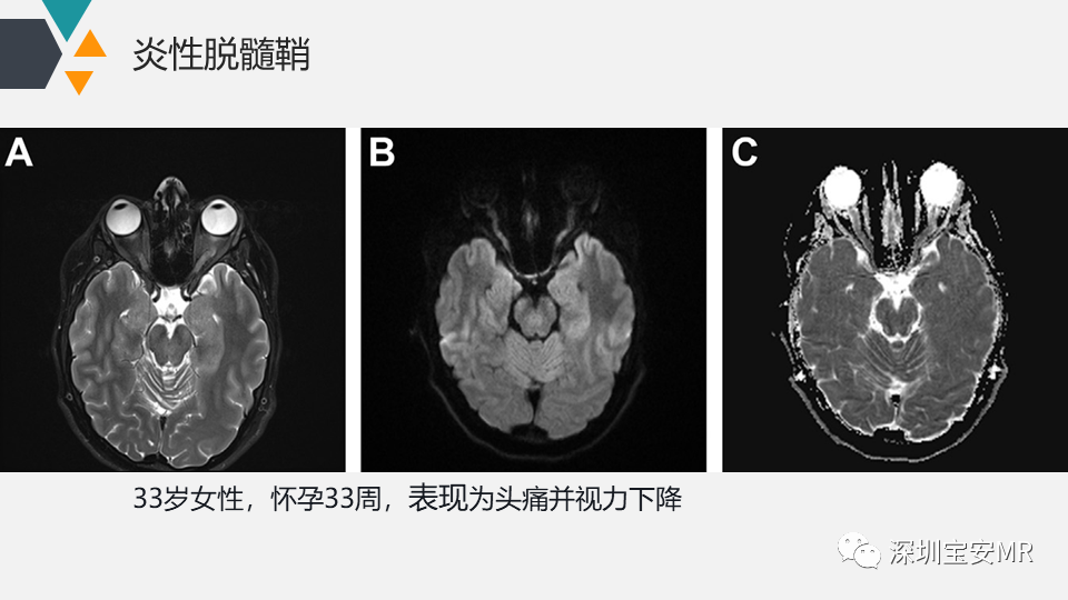 影像PPT - 【PPT】脑神经影像学与相关病变-13