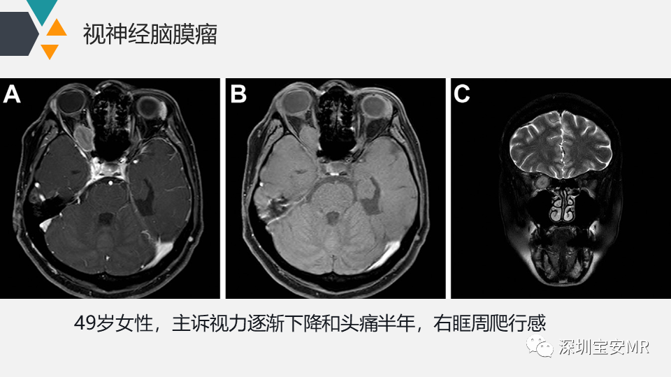 影像PPT - 【PPT】脑神经影像学与相关病变-15