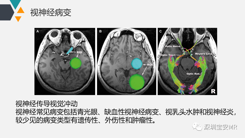 影像PPT - 【PPT】脑神经影像学与相关病变-12