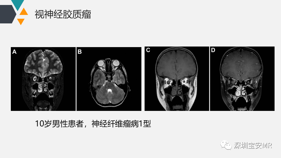 影像PPT - 【PPT】脑神经影像学与相关病变-16