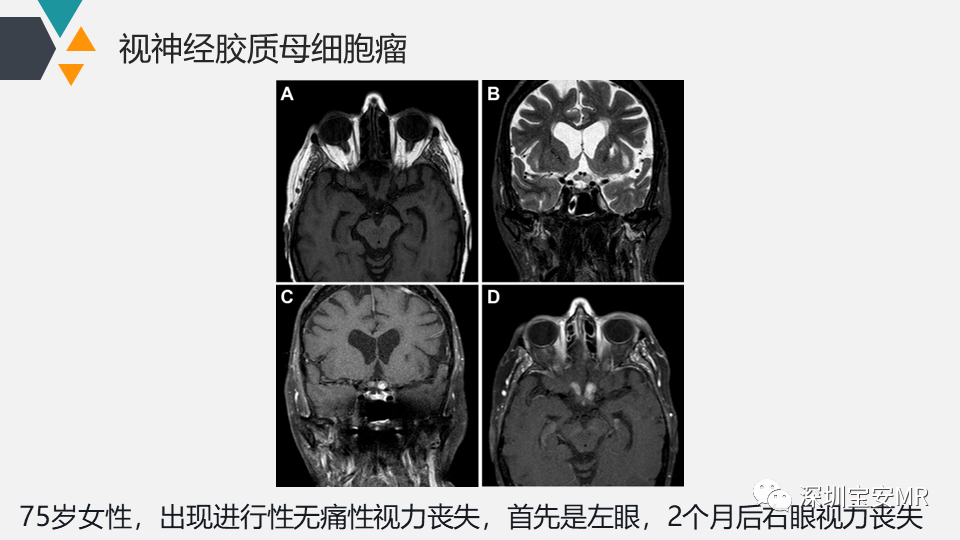 影像PPT - 【PPT】脑神经影像学与相关病变-17