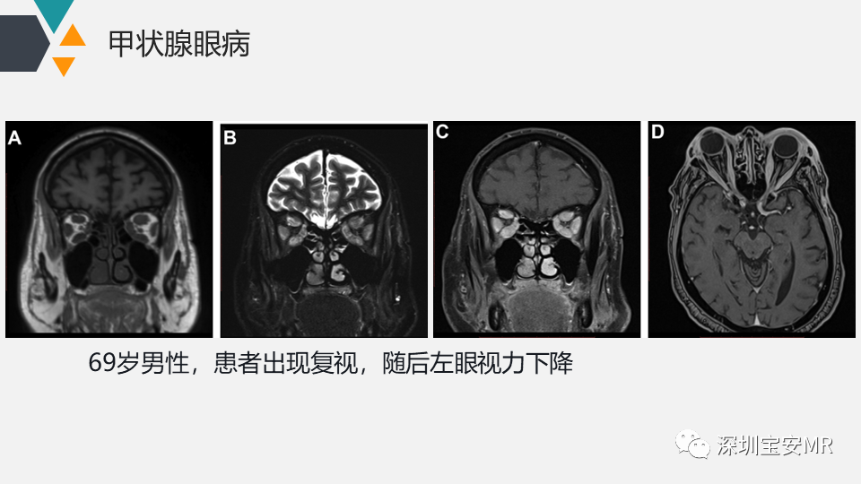 影像PPT - 【PPT】脑神经影像学与相关病变-19