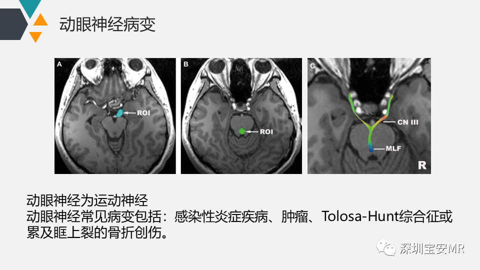 影像PPT - 【PPT】脑神经影像学与相关病变-21