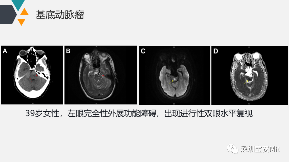 影像PPT - 【PPT】脑神经影像学与相关病变-26