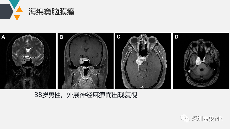 影像PPT - 【PPT】脑神经影像学与相关病变-27