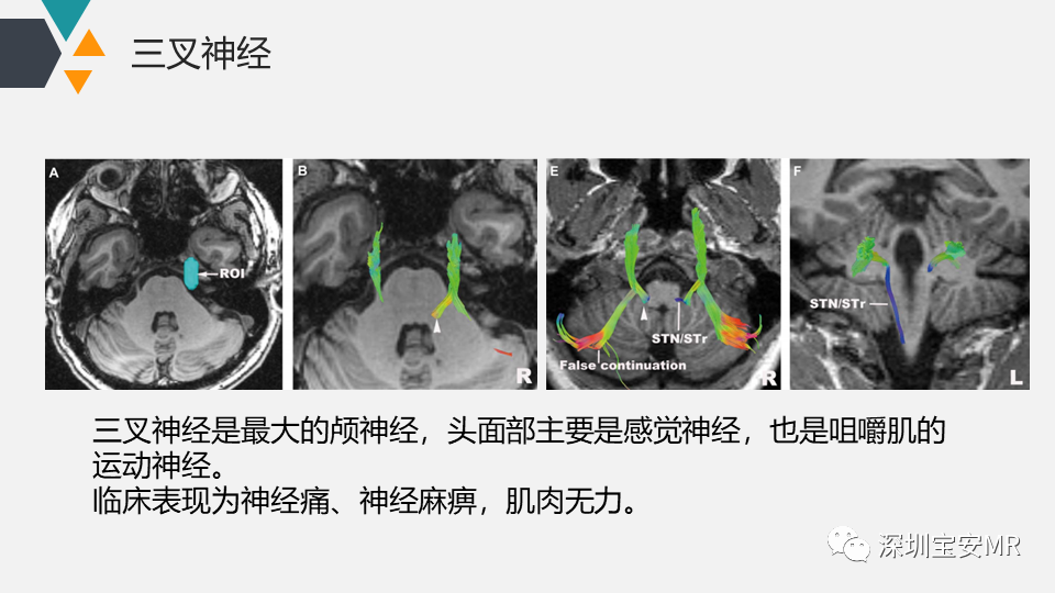 影像PPT - 【PPT】脑神经影像学与相关病变-29