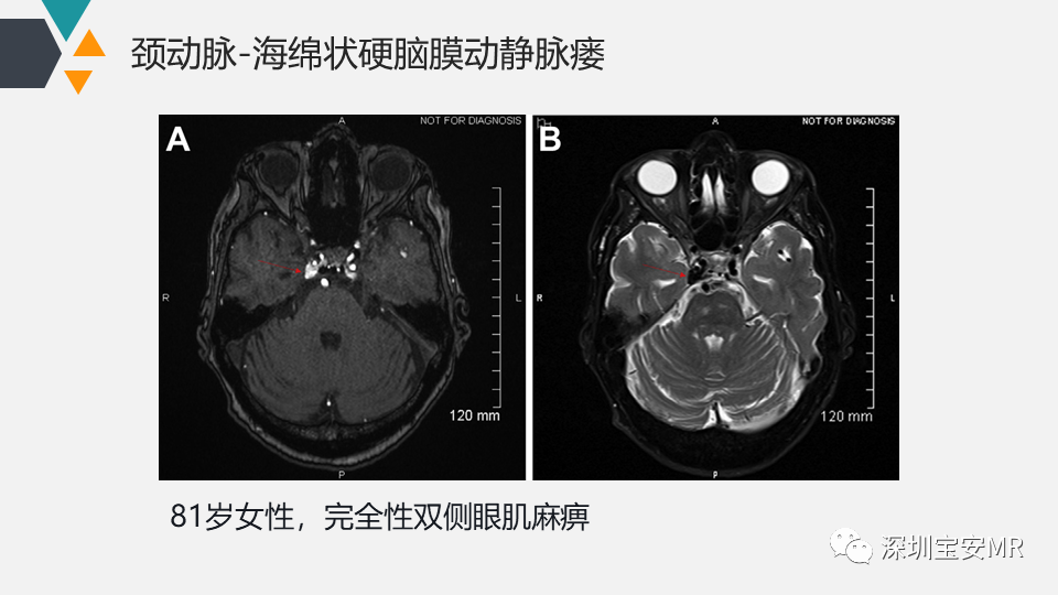 影像PPT - 【PPT】脑神经影像学与相关病变-34