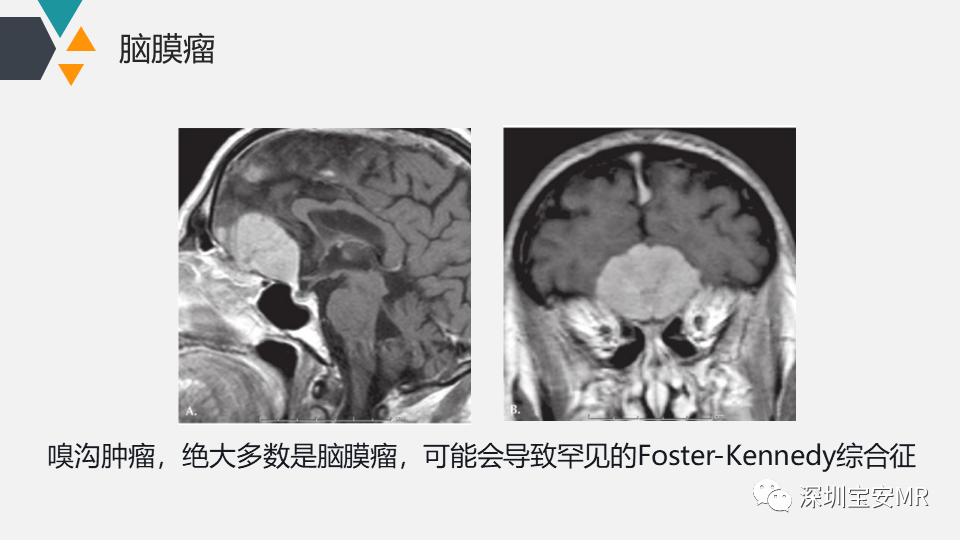 影像PPT - 【PPT】脑神经影像学与相关病变-1