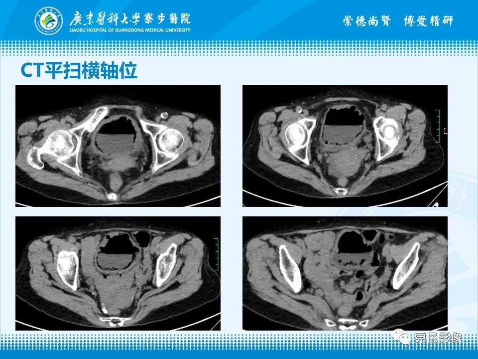影像PPT - 【PPT】气肿性膀胱炎CT表现-3