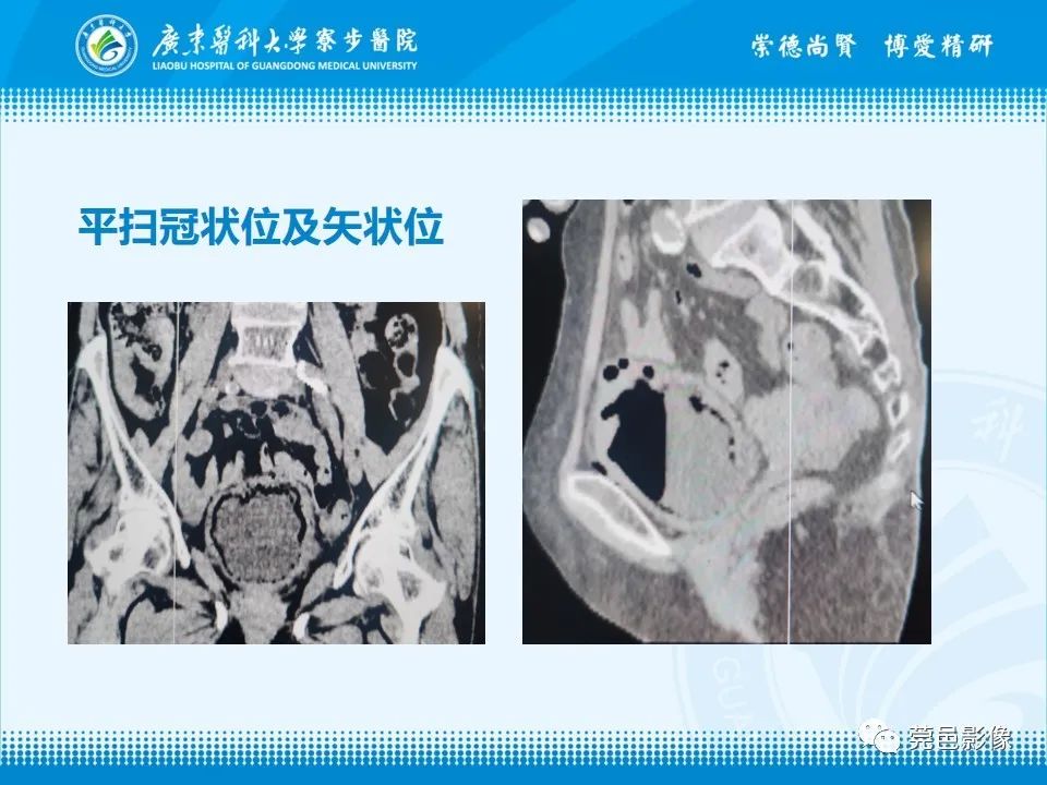 影像PPT - 【PPT】气肿性膀胱炎CT表现-4