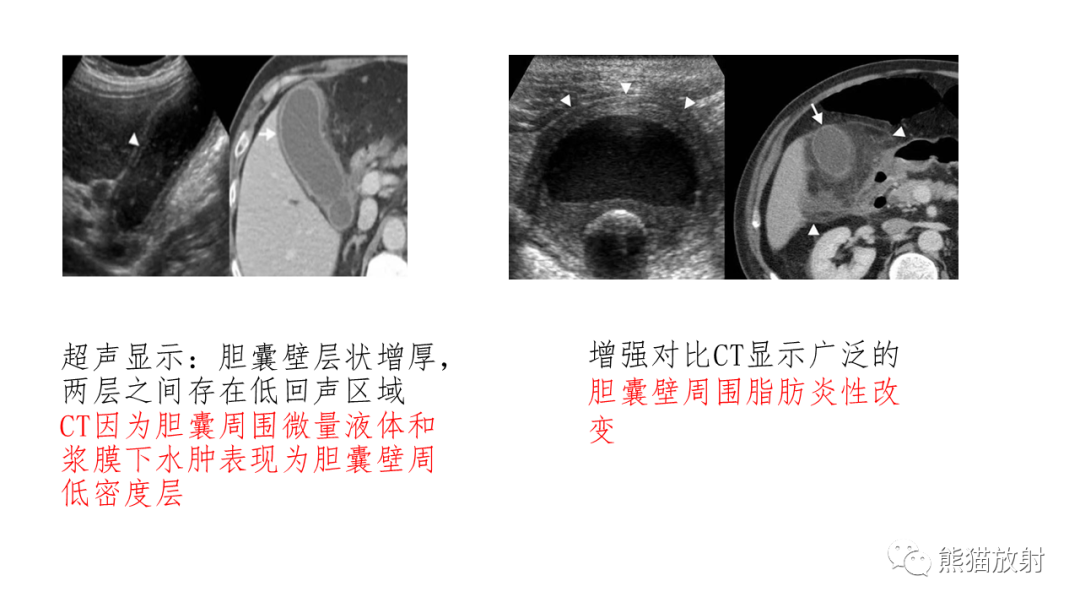 影像PPT - 【病例】黄色肉芽肿性胆囊炎 VS 胆囊癌-26