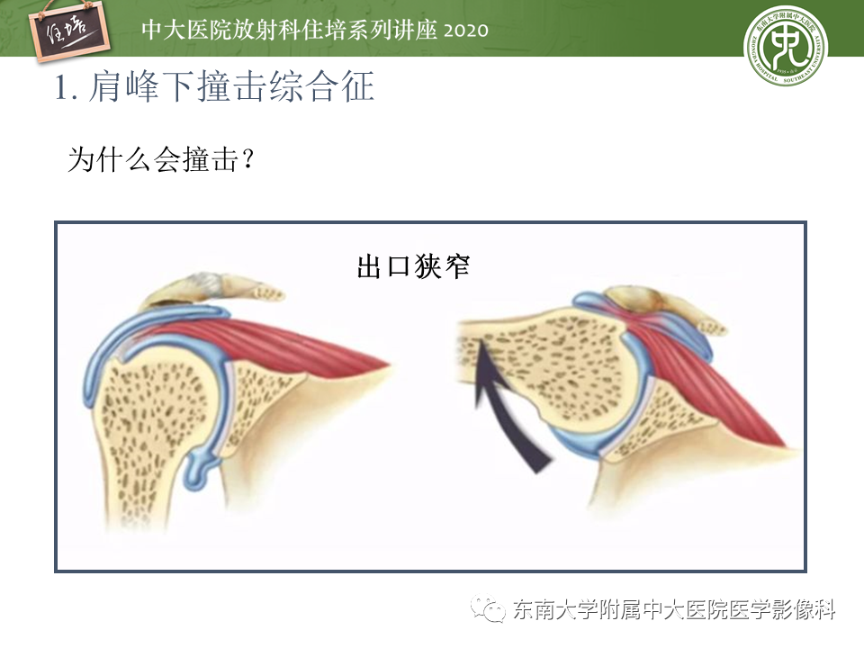 影像PPT - 【PPT】常见撞击综合征的影像诊断-4