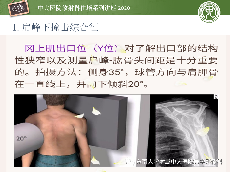 影像PPT - 【PPT】常见撞击综合征的影像诊断-5