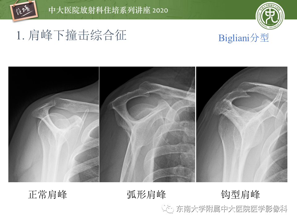 影像PPT - 【PPT】常见撞击综合征的影像诊断-6