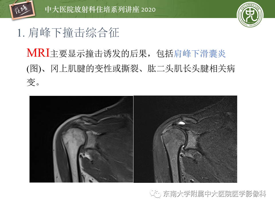 影像PPT - 【PPT】常见撞击综合征的影像诊断-8