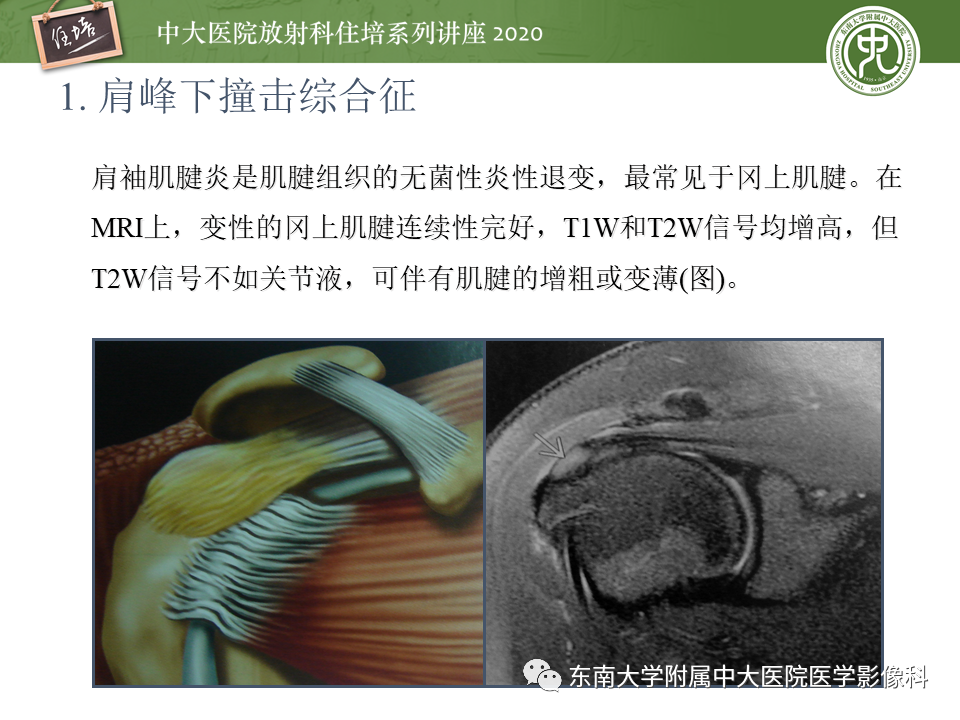 影像PPT - 【PPT】常见撞击综合征的影像诊断-9