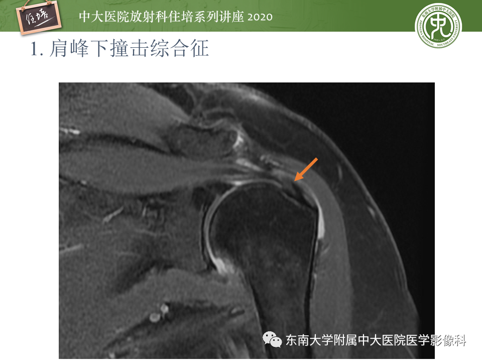 影像PPT - 【PPT】常见撞击综合征的影像诊断-10