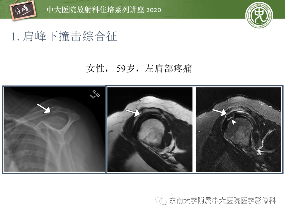 影像PPT - 【PPT】常见撞击综合征的影像诊断-11