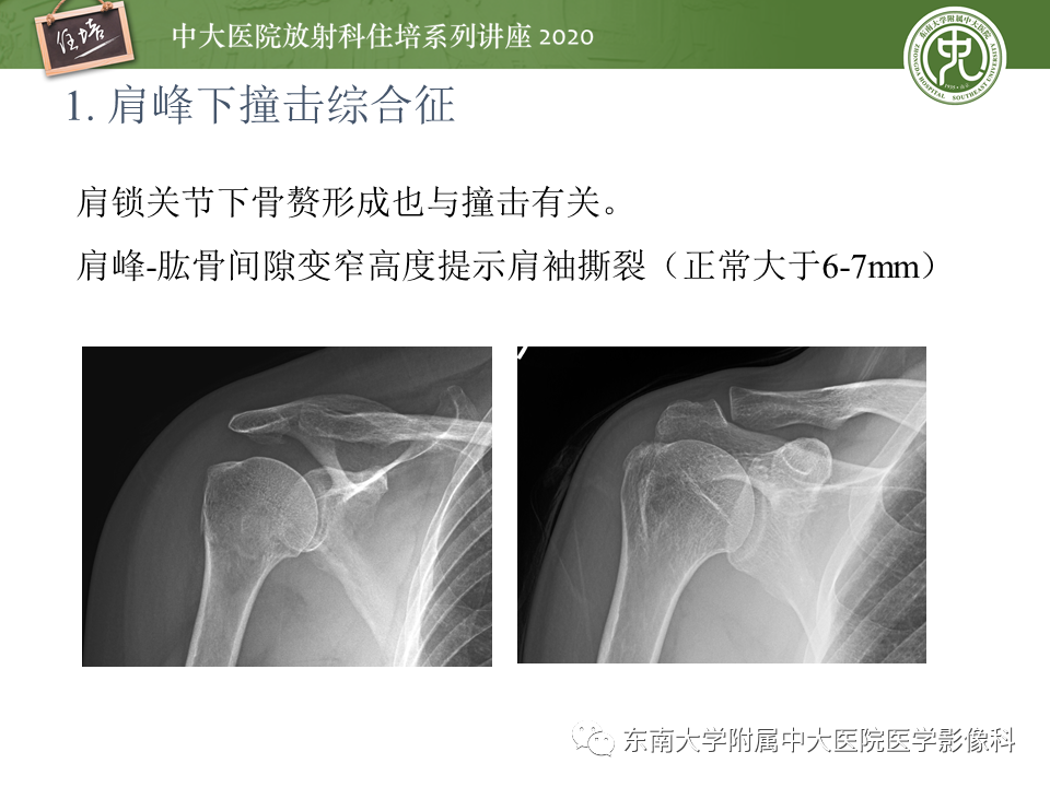 影像PPT - 【PPT】常见撞击综合征的影像诊断-7