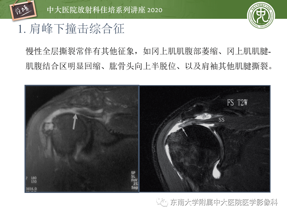 影像PPT - 【PPT】常见撞击综合征的影像诊断-12
