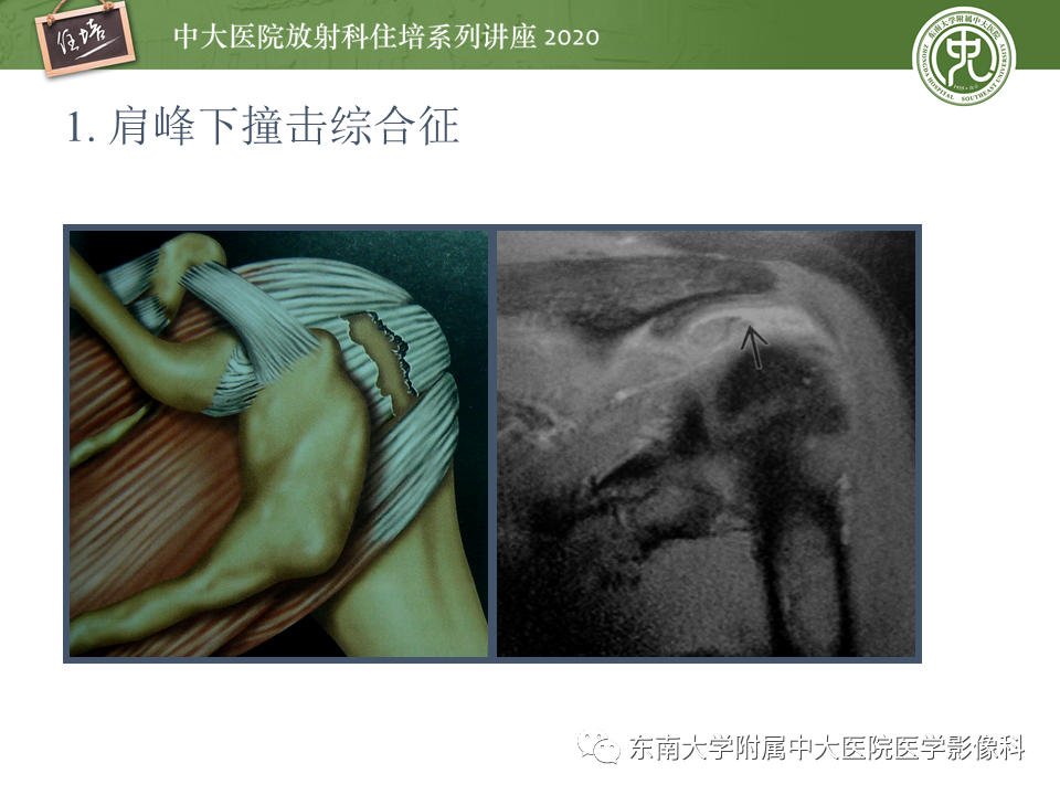 影像PPT - 【PPT】常见撞击综合征的影像诊断-13