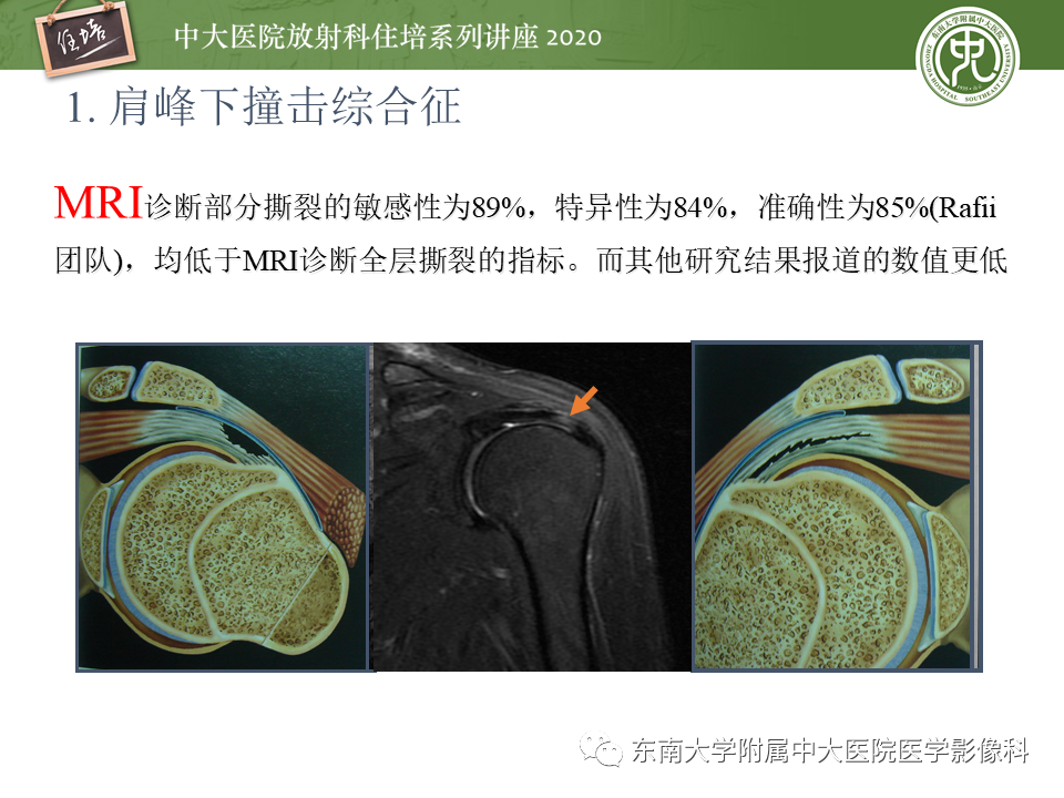 影像PPT - 【PPT】常见撞击综合征的影像诊断-15