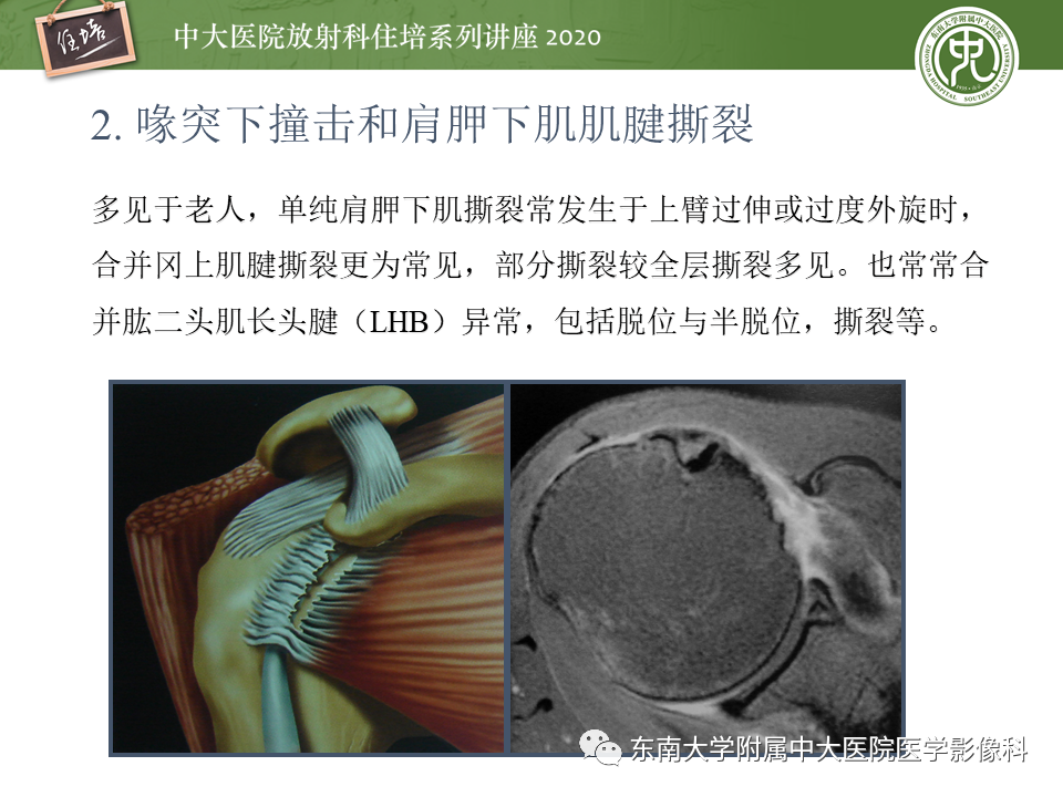 影像PPT - 【PPT】常见撞击综合征的影像诊断-16