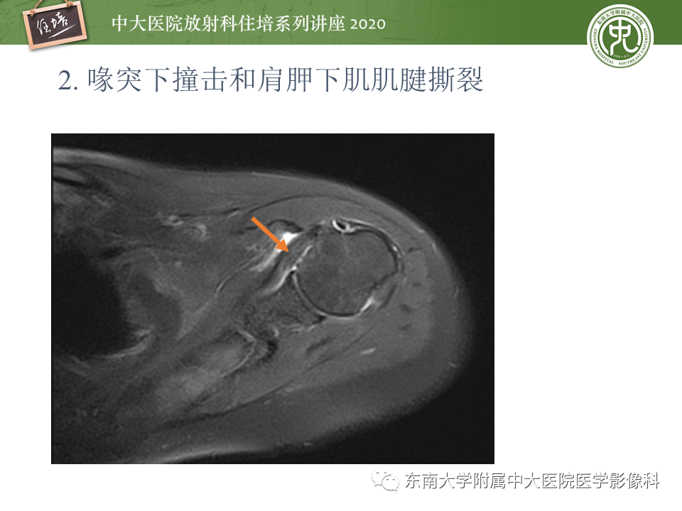 影像PPT - 【PPT】常见撞击综合征的影像诊断-17