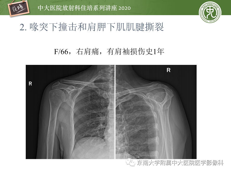 影像PPT - 【PPT】常见撞击综合征的影像诊断-18