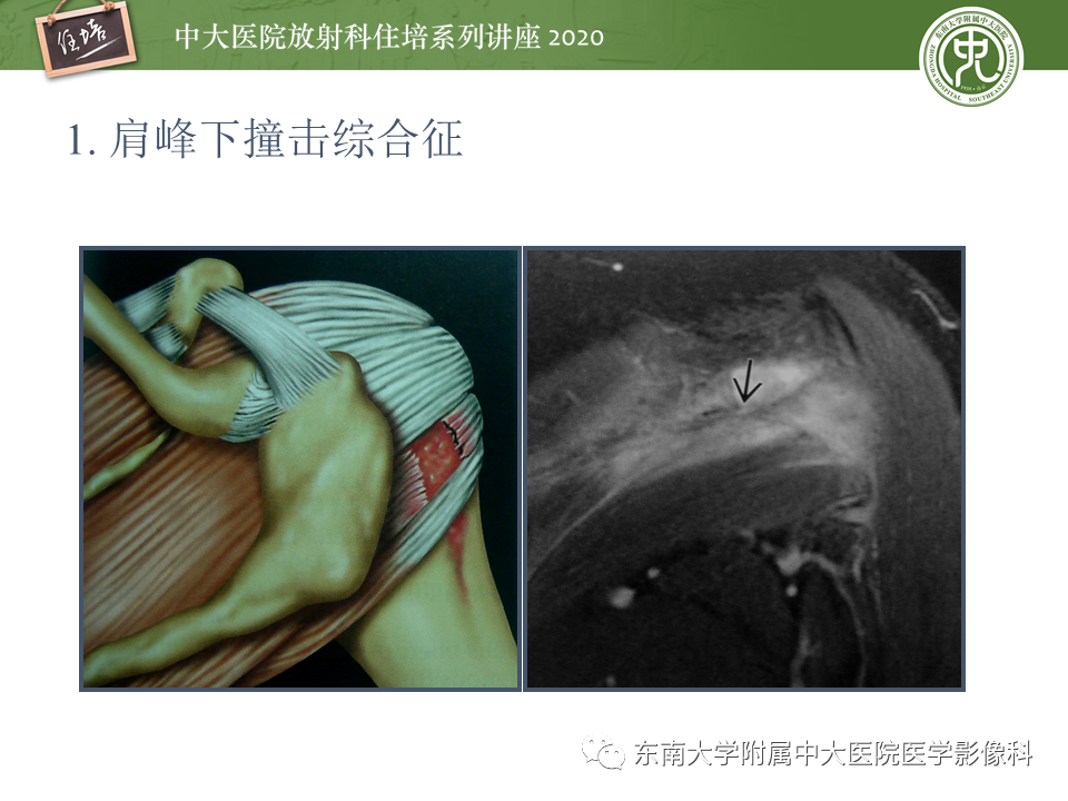 影像PPT - 【PPT】常见撞击综合征的影像诊断-14