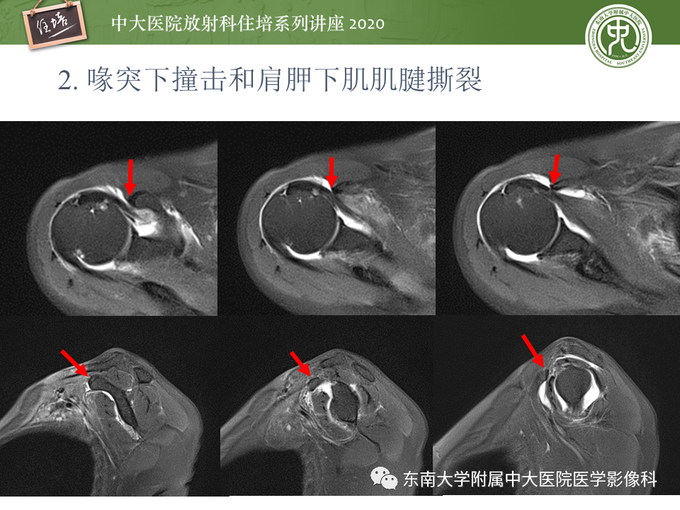 影像PPT - 【PPT】常见撞击综合征的影像诊断-19