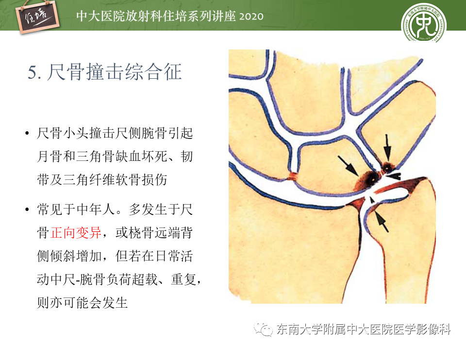 影像PPT - 【PPT】常见撞击综合征的影像诊断-21