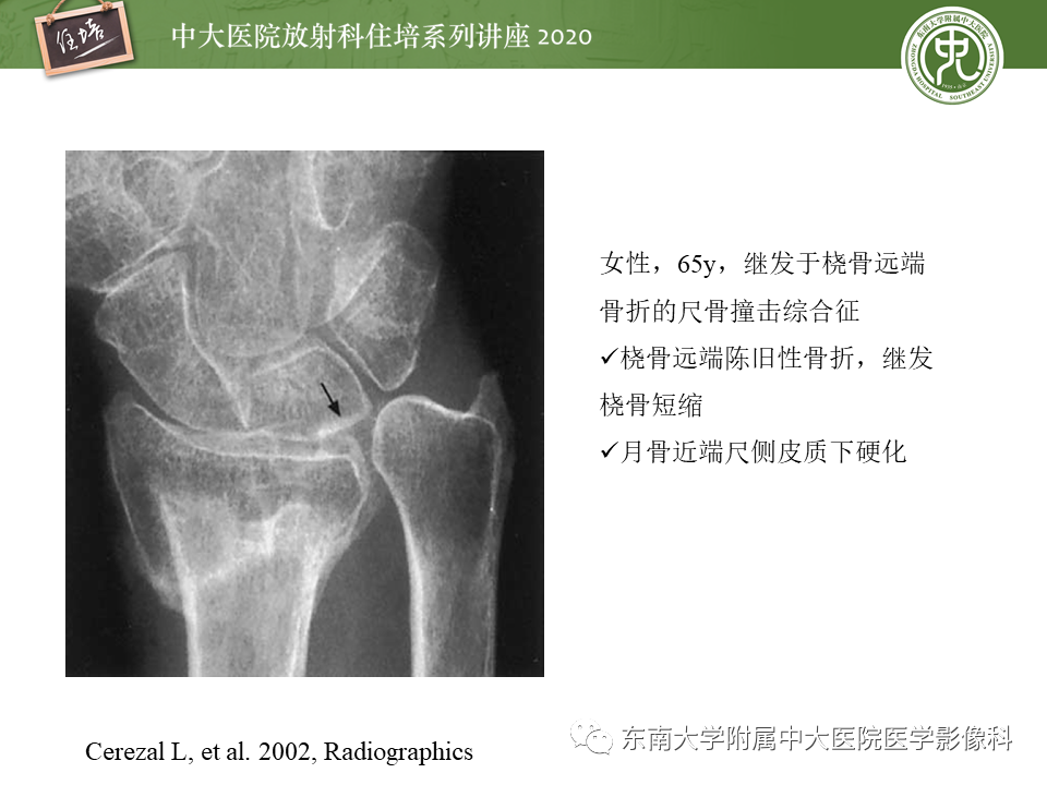 影像PPT - 【PPT】常见撞击综合征的影像诊断-23