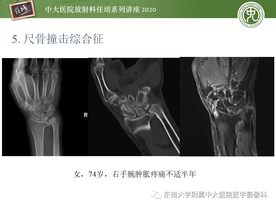 影像PPT - 【PPT】常见撞击综合征的影像诊断-24