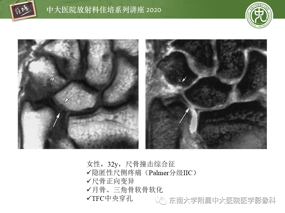 影像PPT - 【PPT】常见撞击综合征的影像诊断-26