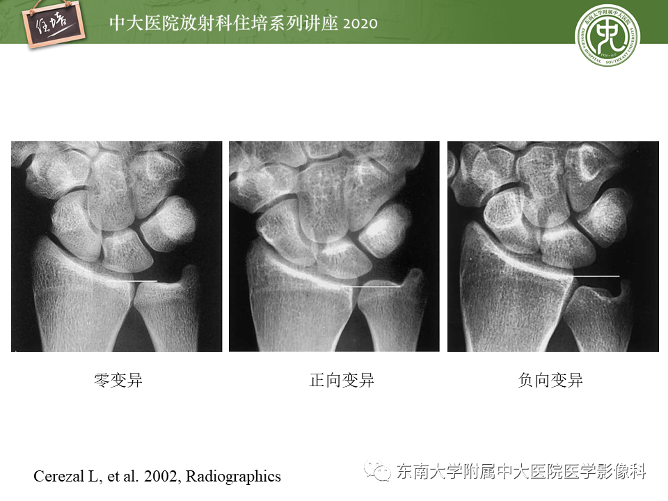 影像PPT - 【PPT】常见撞击综合征的影像诊断-22