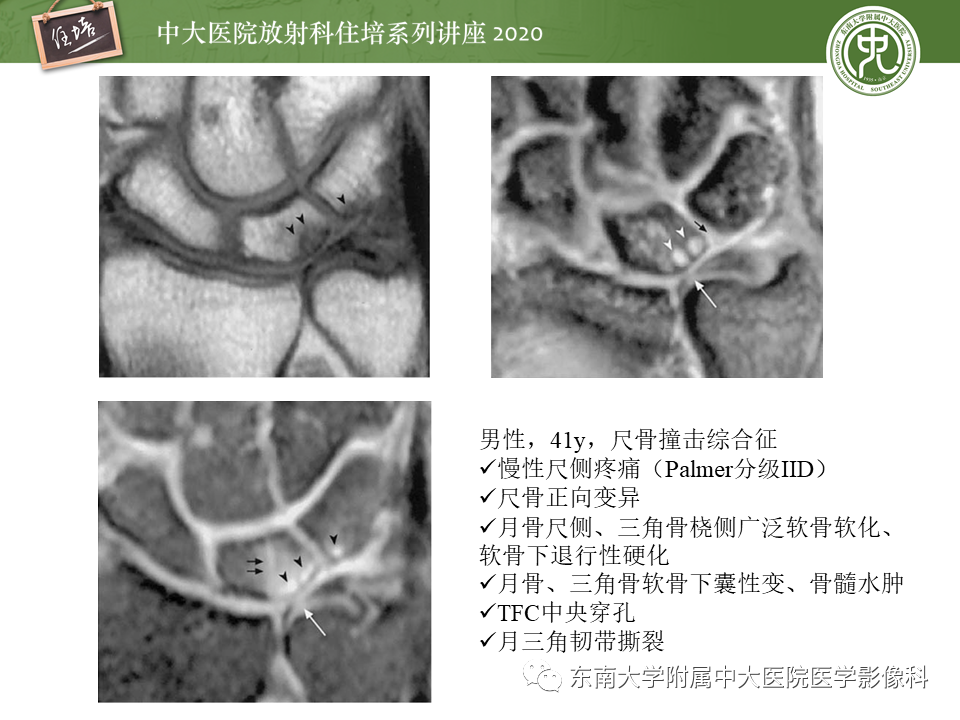 影像PPT - 【PPT】常见撞击综合征的影像诊断-27