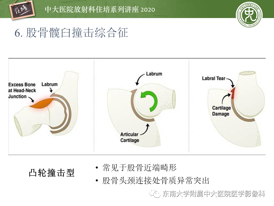 影像PPT - 【PPT】常见撞击综合征的影像诊断-31