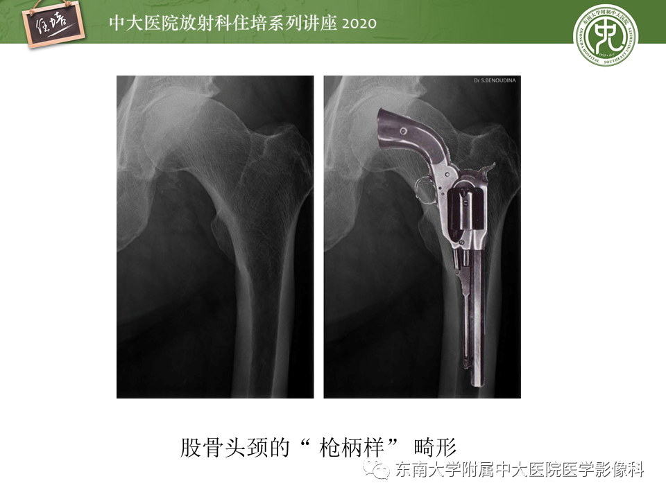 影像PPT - 【PPT】常见撞击综合征的影像诊断-32
