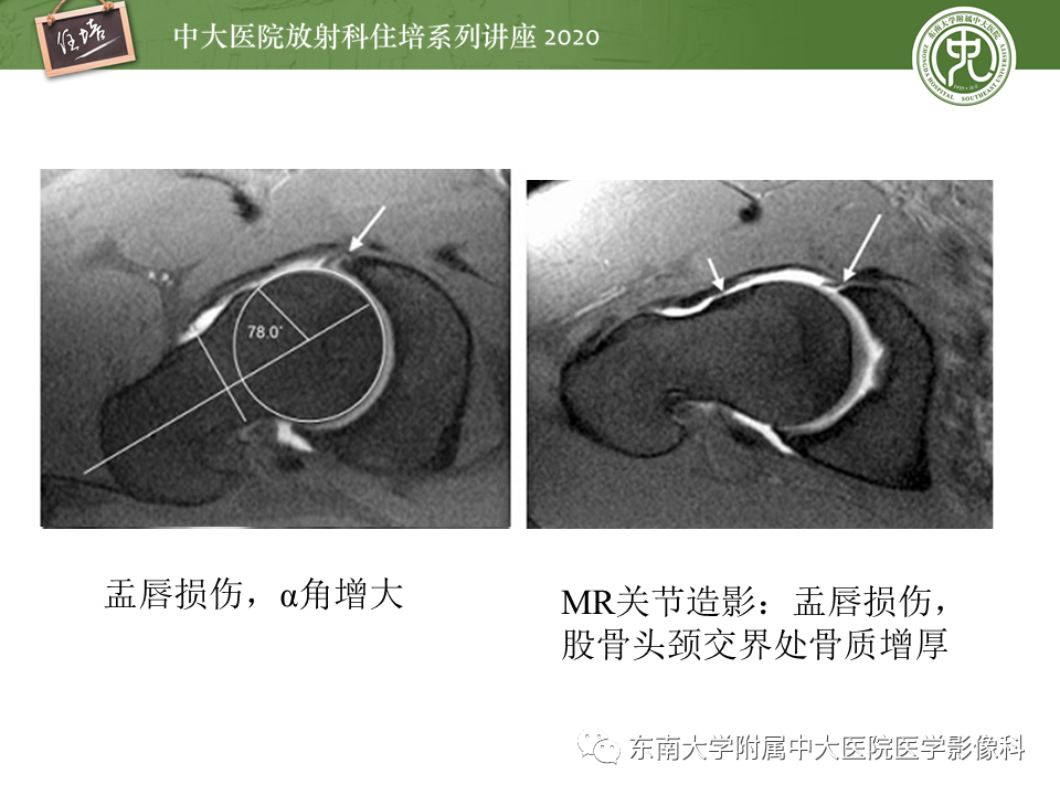 影像PPT - 【PPT】常见撞击综合征的影像诊断-35