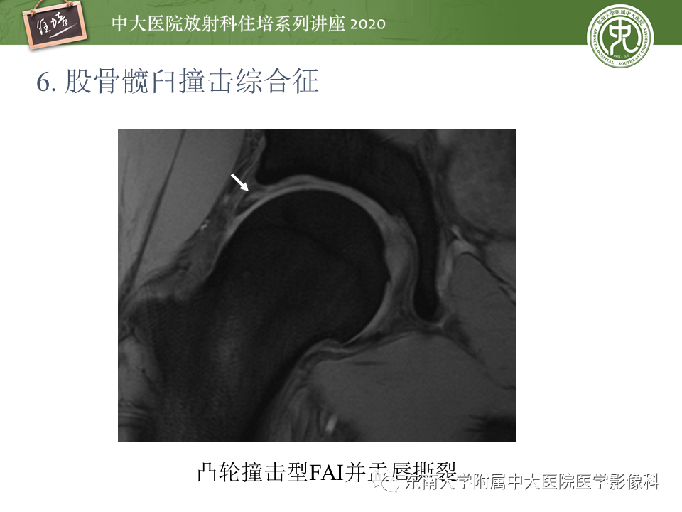 影像PPT - 【PPT】常见撞击综合征的影像诊断-36