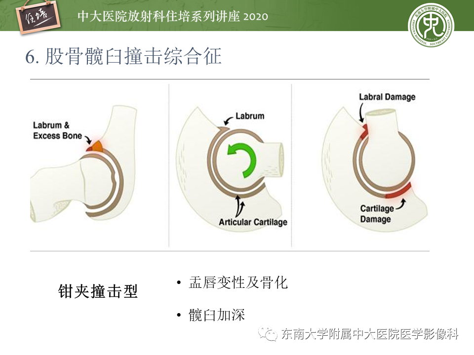 影像PPT - 【PPT】常见撞击综合征的影像诊断-37