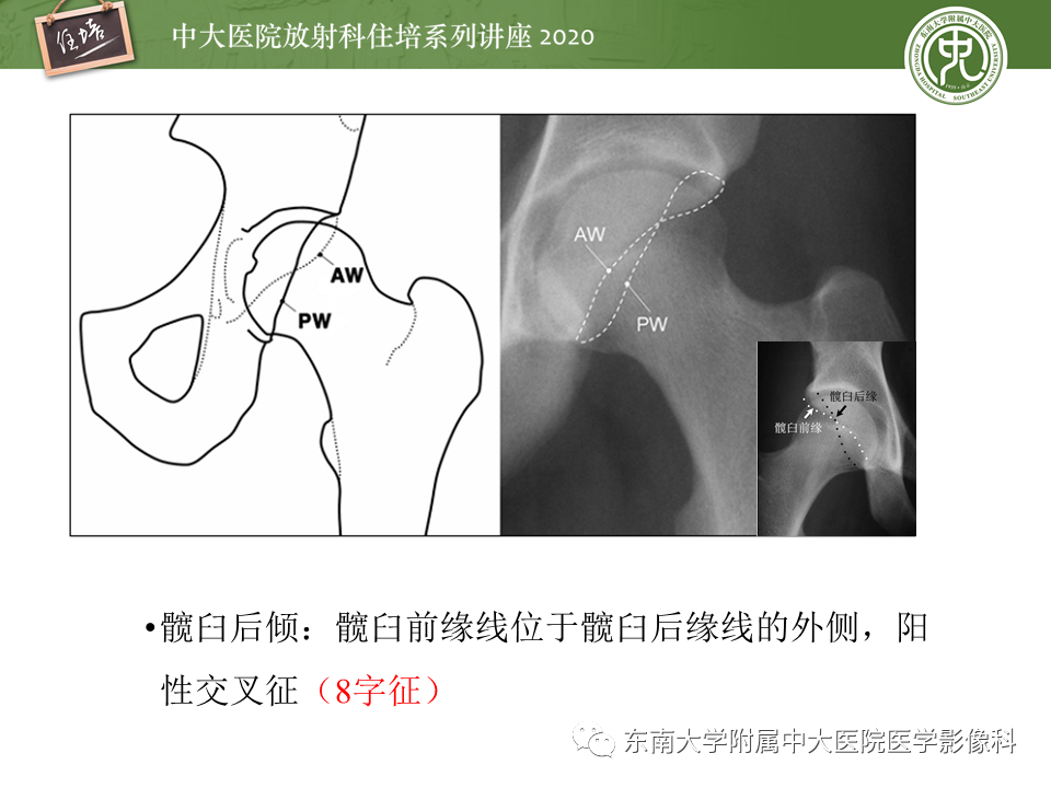 影像PPT - 【PPT】常见撞击综合征的影像诊断-39