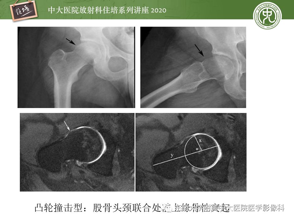 影像PPT - 【PPT】常见撞击综合征的影像诊断-34